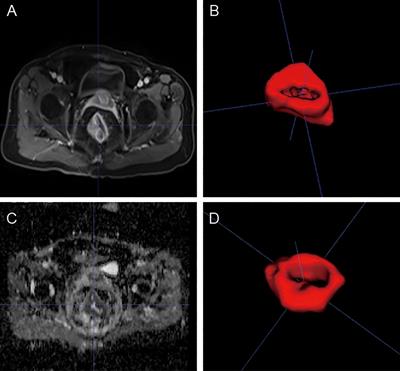 Prediction by a multiparametric magnetic resonance imaging-based radiomics signature model of disease-free survival in patients with rectal cancer treated by surgery